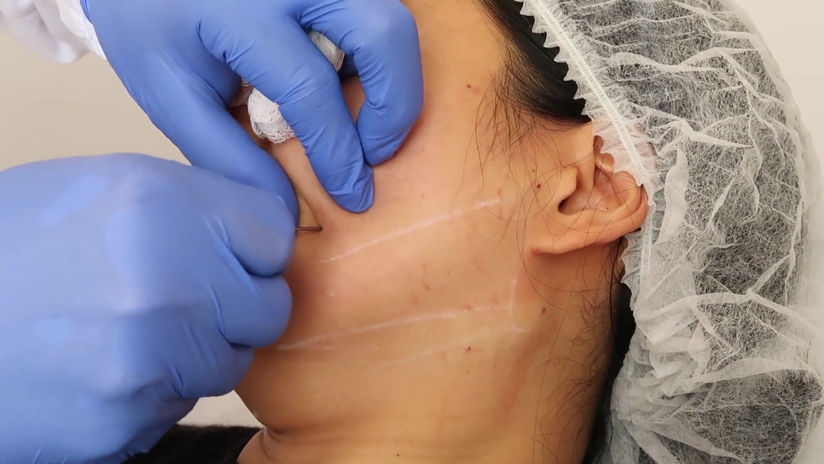Mandible / Neck Lift (Reverse & Traditional Technique)